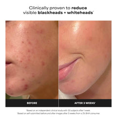 Paula's Choice Skin Perfecting 2% BHA Liquid Exfoliant (118ml)